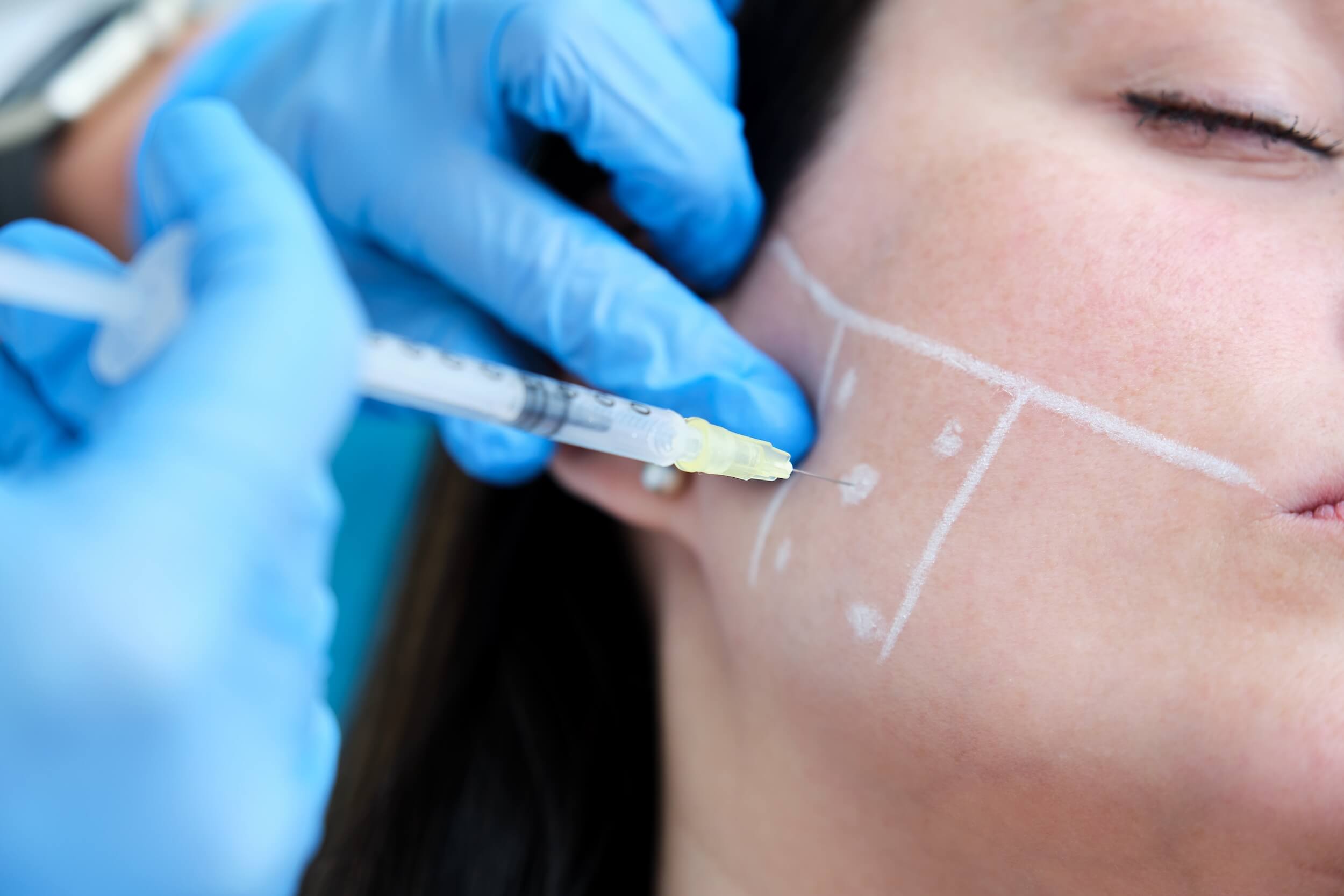 botox for migraines reviews