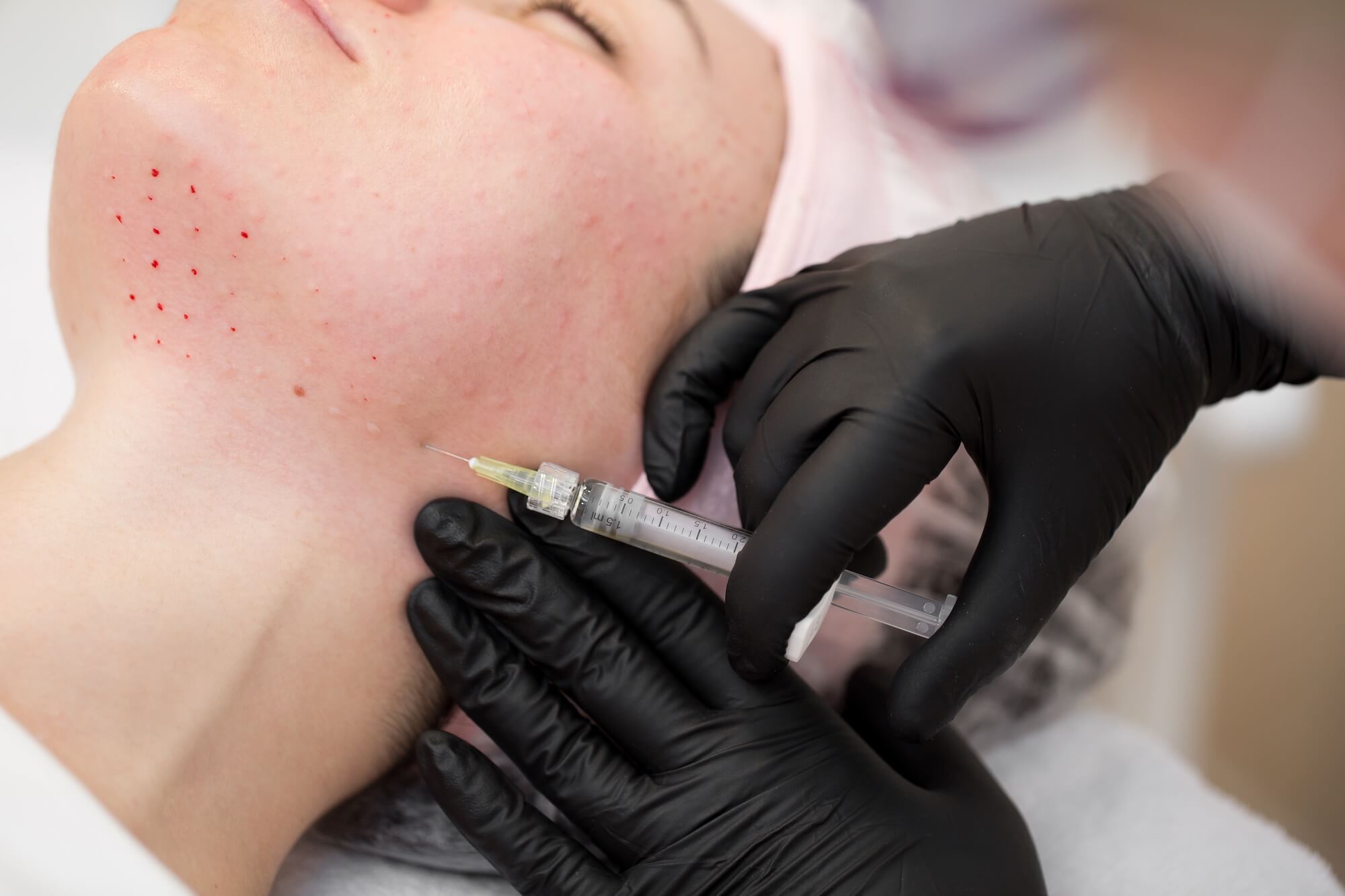 botox for tmj reviews