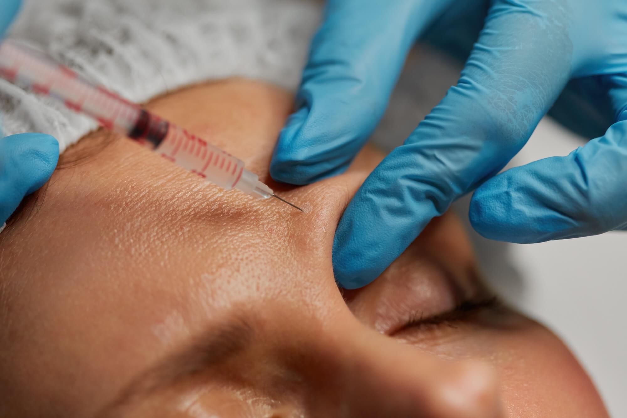 dermal fillers side effects