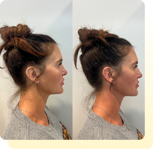 bellafill before and aftercare