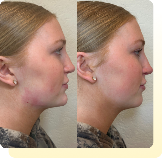 bellafill before and after care