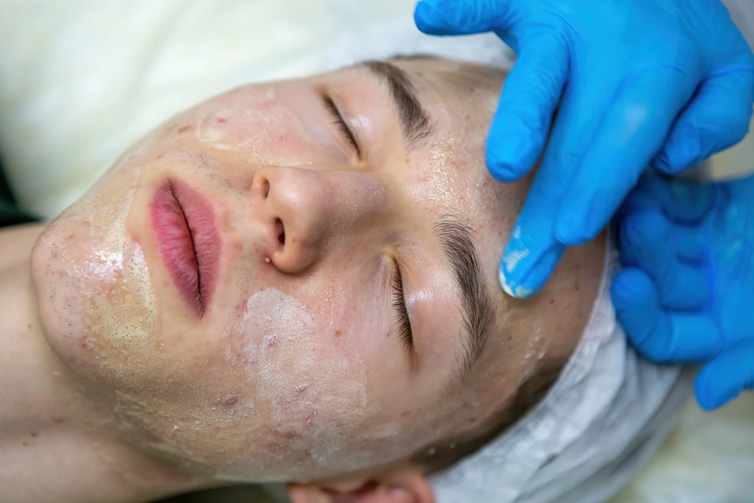 med spa chemical peel