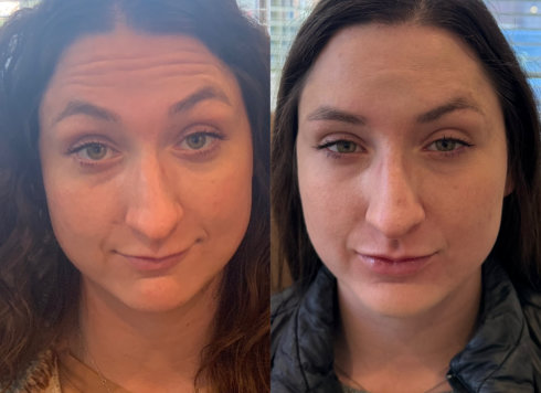 Young woman showing the effectiveness of Botox services at InjectCo's med spa in The Woodlands, with side-by-side comparison of forehead expression lines before and after treatment.