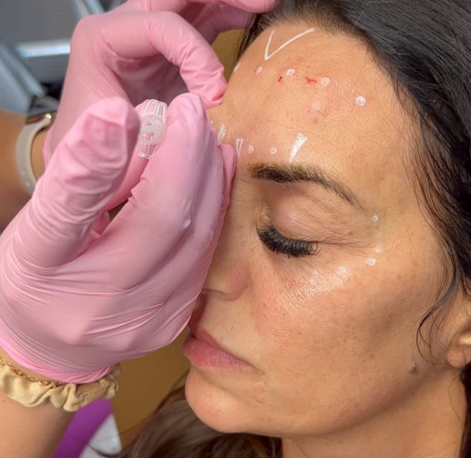Young woman receiving treatment as part of a Botox club membership in the Woodlands