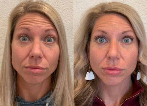 Comparison of forehead expression lines before and after a Botox savings plan treatment at InjectCo's med spa in The Woodlands, illustrating natural-looking results and youthful radiance.