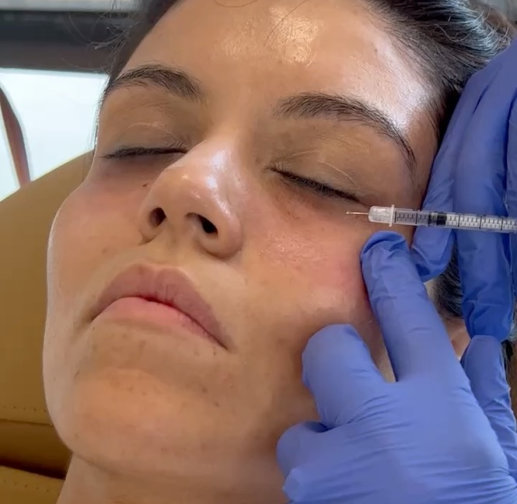 Young woman getting Botox services for crow's feet at InjectCo's med spa in The Woodlands.