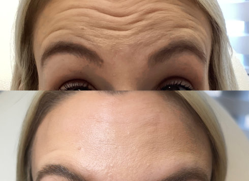 Before and after results for a Botox membership at InjectCo's med spa in The Woodlands, showing a significant reduction in deep forehead wrinkles and smooth skin texture.