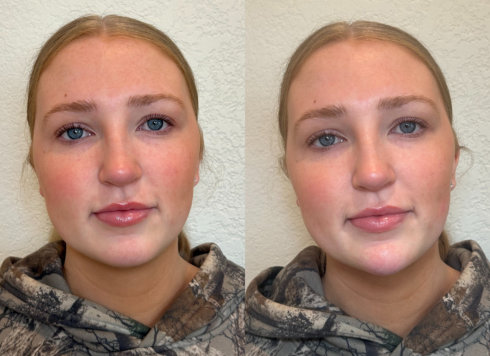 Jawline Filler Before and After