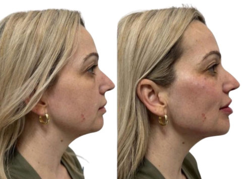 Jawline Filler Before and After