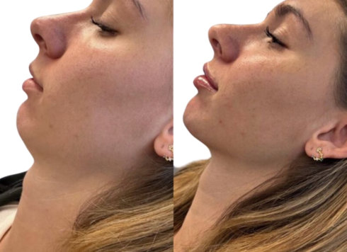 Jawline Filler Before and After
