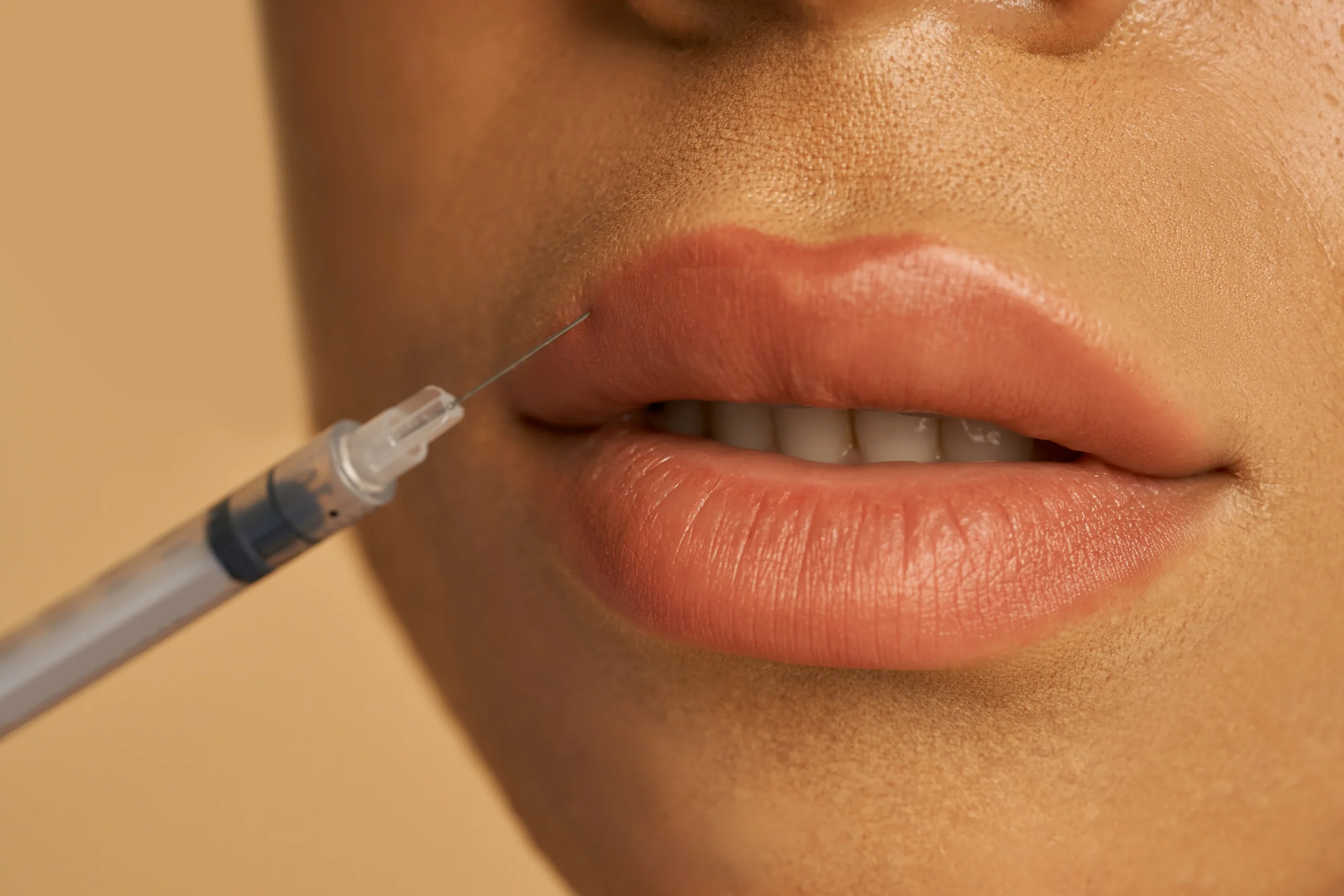 lip filler myths