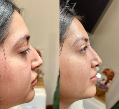 Woman getting botox services at InjectCo’s med spa in Colleyville.