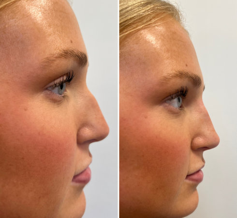 Woman getting botox services at InjectCo’s med spa in Fort Worth.