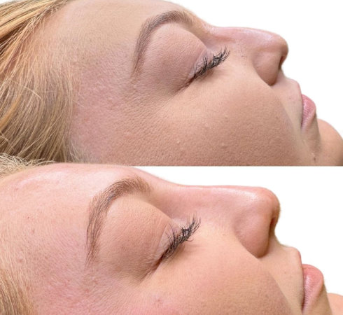 InjectCo offers botox services in and around Argyle