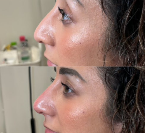 Woman getting botox services at InjectCo’s med spa in Fort Worth.