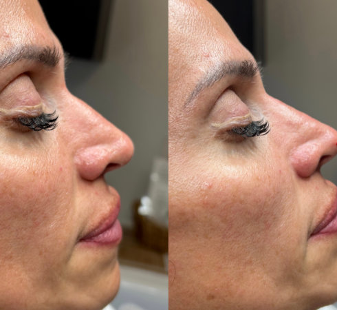 InjectCo offers botox services in and around Dallas