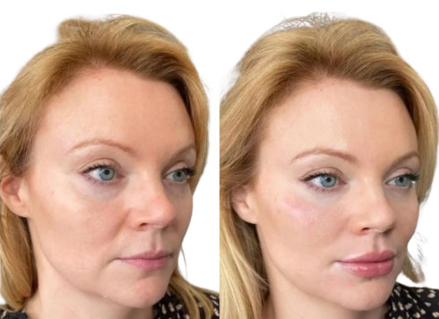 Nasolabial Filler Before and After
