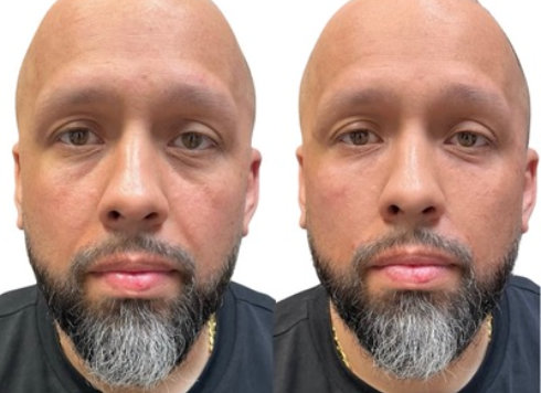 Nasolabial Filler Before and After