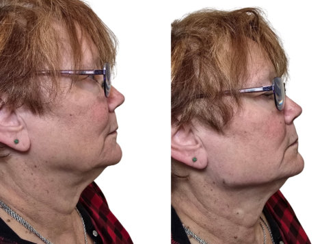 Neck Rejuvenation Before and After