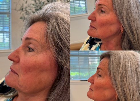 Neck Rejuvenation Before and After