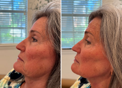 Neck Rejuvenation Before and After