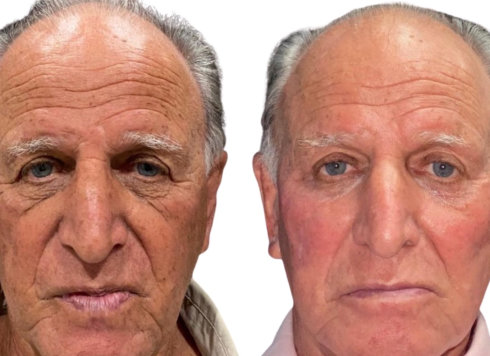 Undereye Filler Before and Aftee