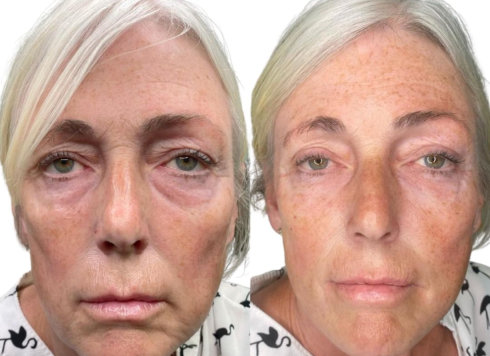 Undereye Filler Before and Aftee