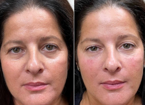 Undereye Filler Before and Aftee