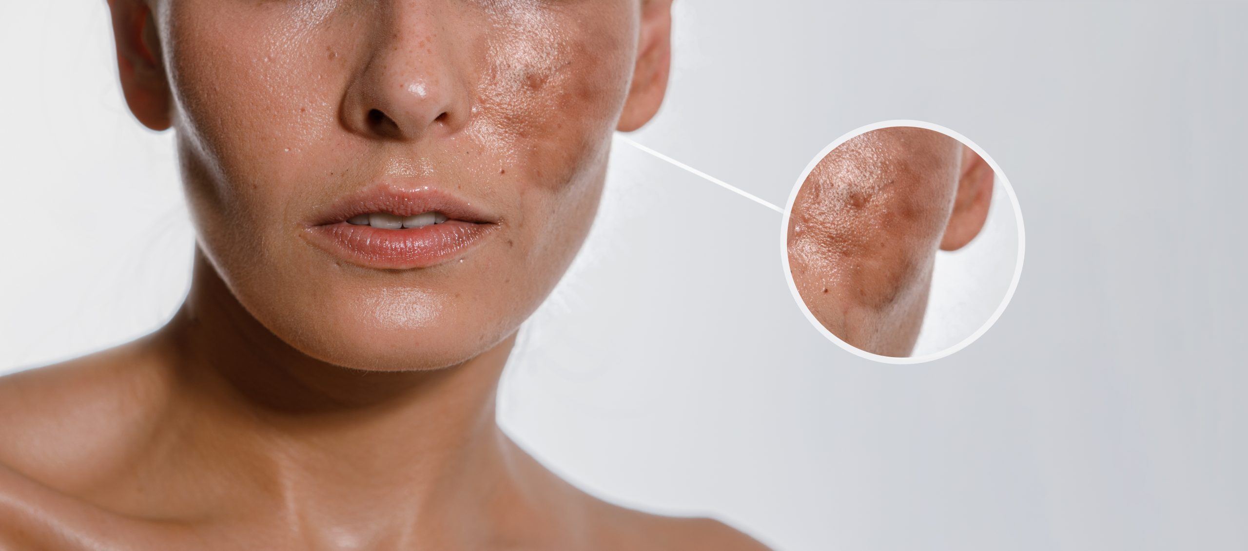 melasma vs dark spots