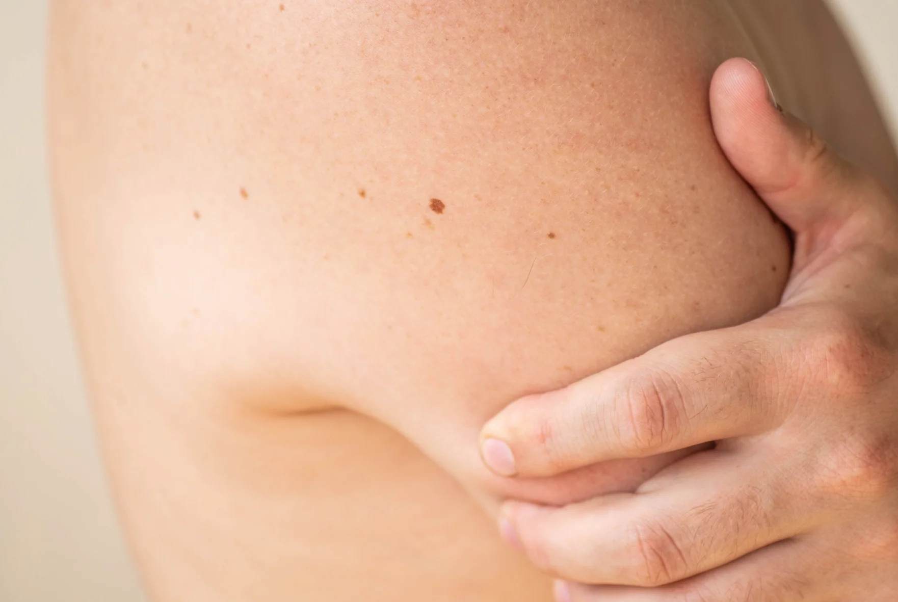Laser Hair Removal for Hidradenitis Suppurativa (HS): Does It Work?