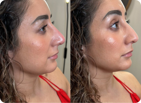 Nurse injector assessing a patient nasal profile before placing hyaluronic acid filler