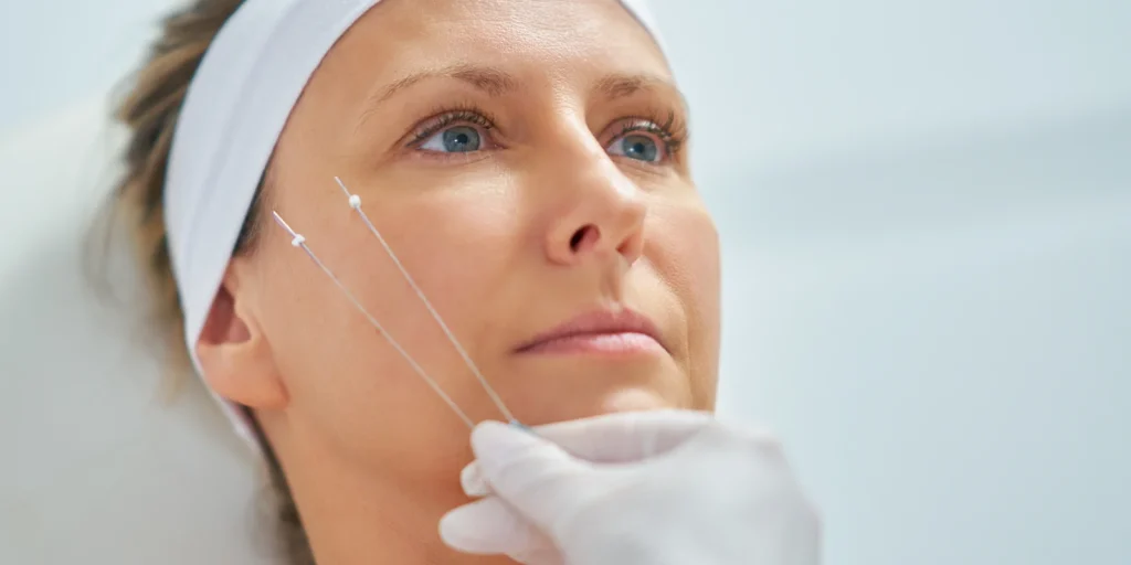 PDO thread lift cost in Texas guide from the nurse injectors at InjectCo MedSpa