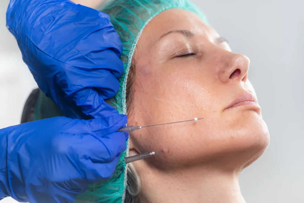 InjectCo nurse injector explaining PDO thread lift cost options to a patient in Texas