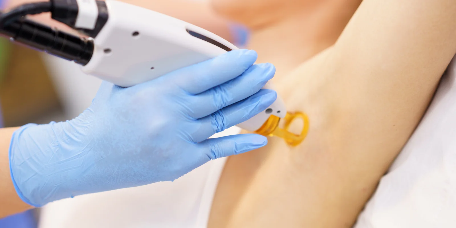 What Underarm Laser Hair Removal Actually Costs (And Why It’s Worth Every Penny)
