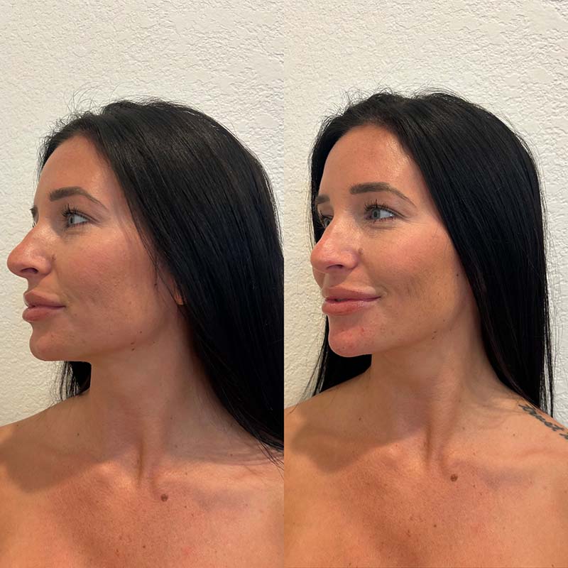 Med spa Mansfield TX nurse injector treatment InjectCo