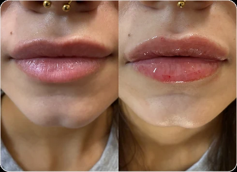 Lip filler before and after, front view, InjectCo patient