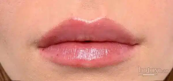 Lips after lip filler, front view, InjectCo patient