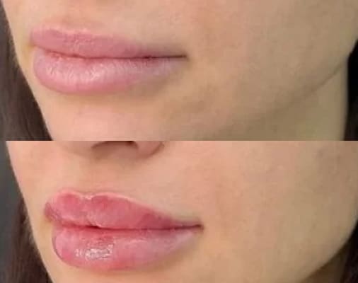 Lip filler before and after, close-up of the lips, InjectCo patient
