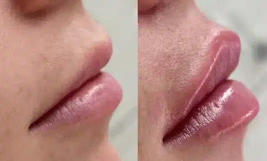 Lip filler before and after, side profile, InjectCo patient