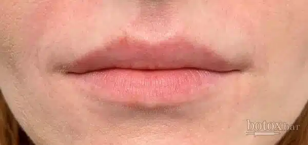 Lips before lip filler, front view, InjectCo patient