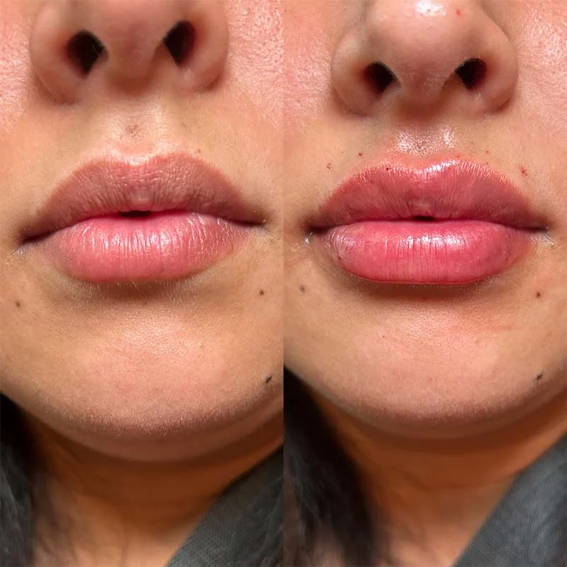 Lip filler syringe size comparison, half syringe versus full syringe Close up of lips showing the difference between a half syringe and a full syringe of filler