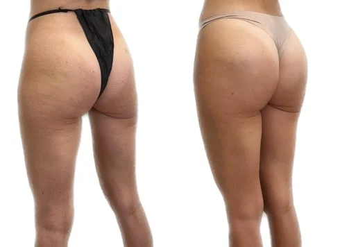 Liquid BBL before and after, InjectCo MedSpa patient in Texas Non surgical liquid BBL before and after result on an InjectCo MedSpa patient